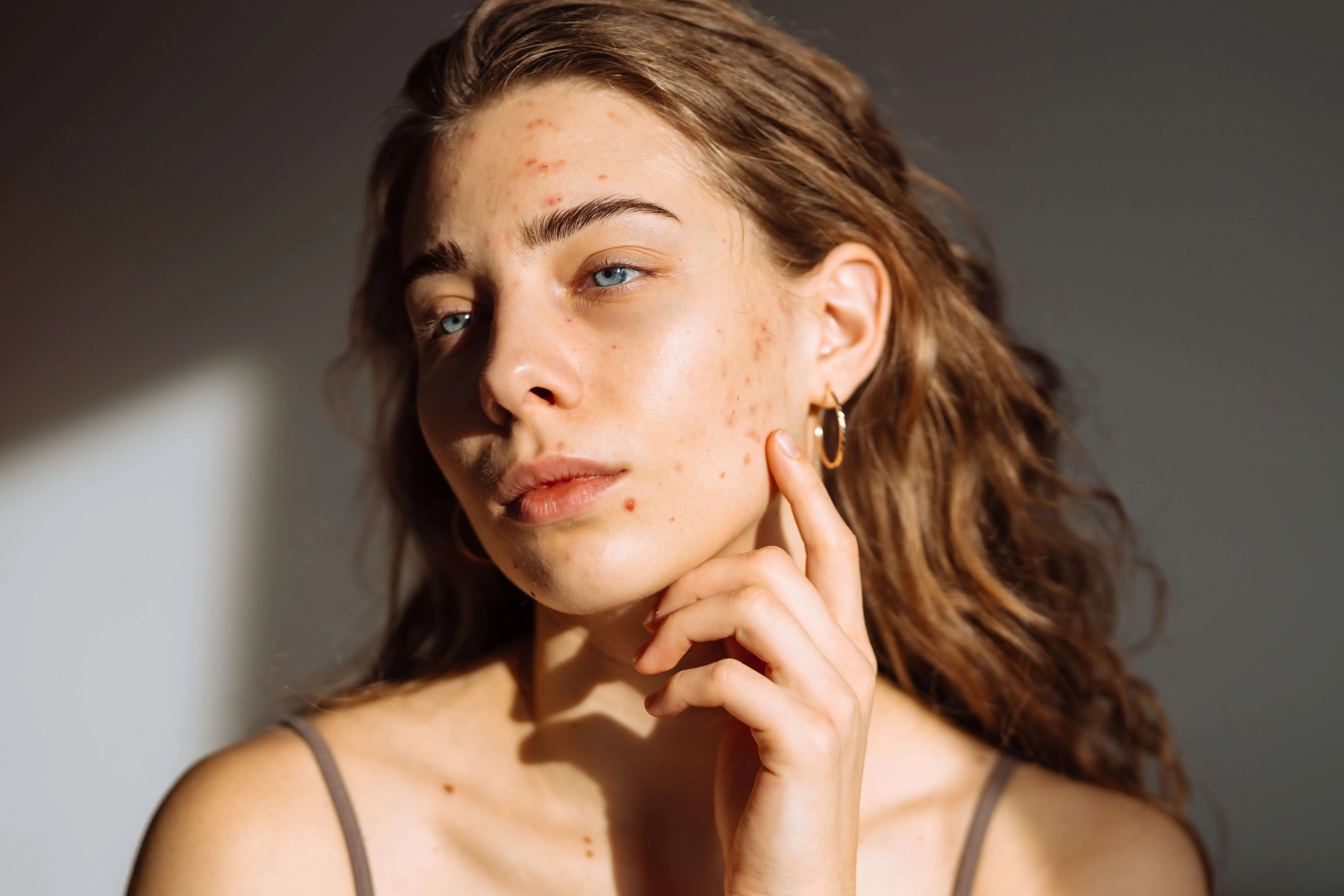 Close up of clear, healthy skin after a course of acne clearing treatments