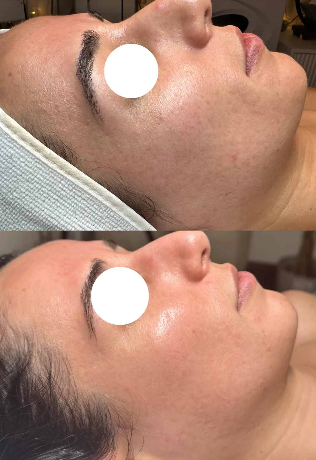 Collagen Induction Therapy case study, before and after at SORA Skin & Ritual House