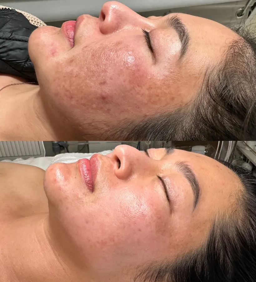 Brighter, more even tone, real before and after at SORA Skin & Ritual House in Peoria, AZ